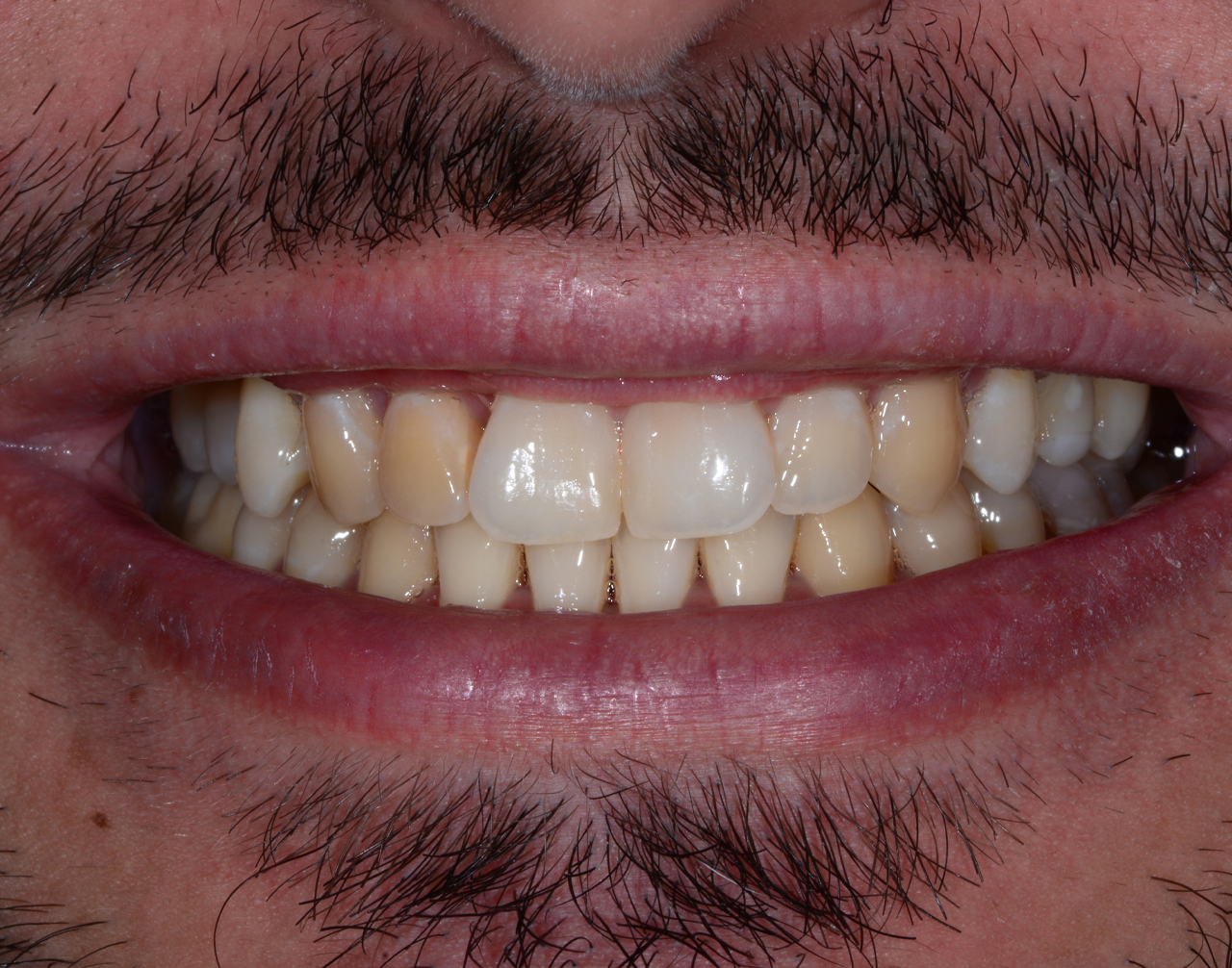antes-4